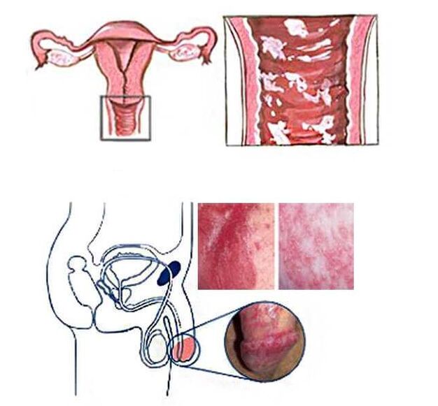 female and male candidiasis as a cause of pathological discharge